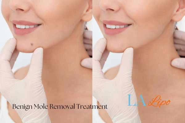 woman's before and after mole removal Stratford New Town results