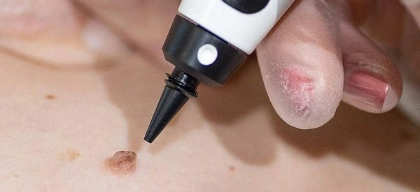 skin tag removal using cryopen Stratford New Town