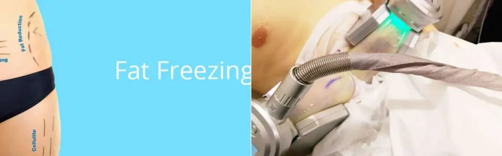 Fat freezing Stratford New Town on multiple areas of the body