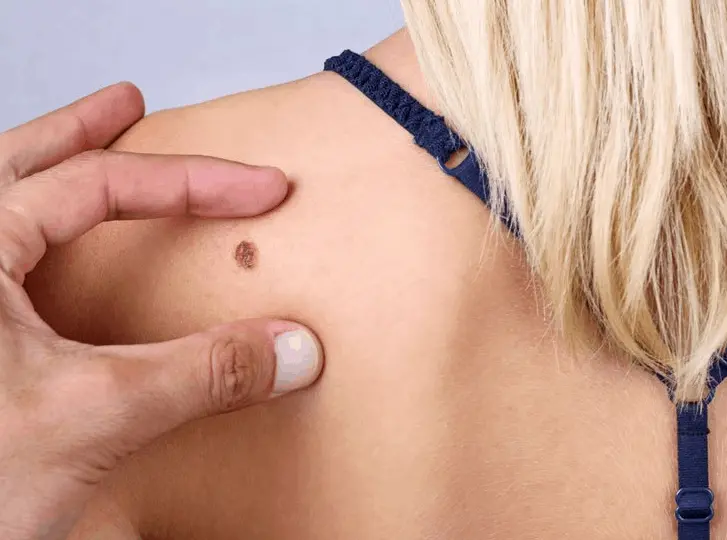 woman having mole removal Stratford New Town consultation before treatment.