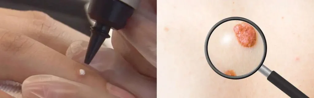 Cryopen for mole removal Stratford New Town - speak to our team today!