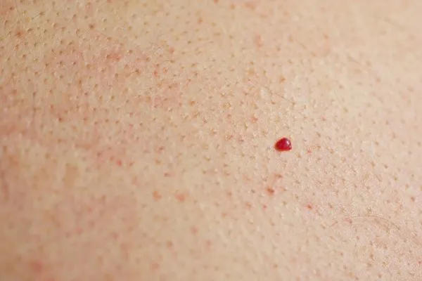 close up of a cherry angioma Stratford New Town