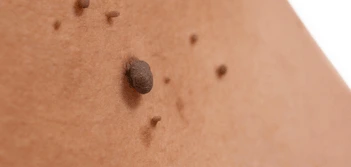 image of a skin tag Stratford New Town