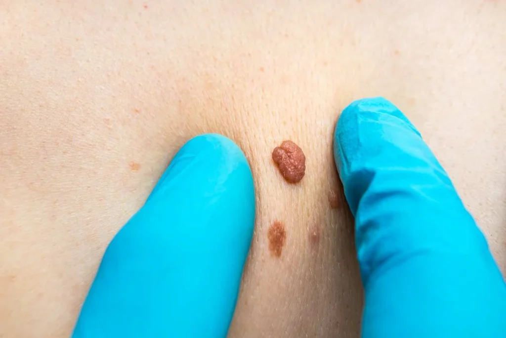Consultant examining a skin tag Stratford New Town