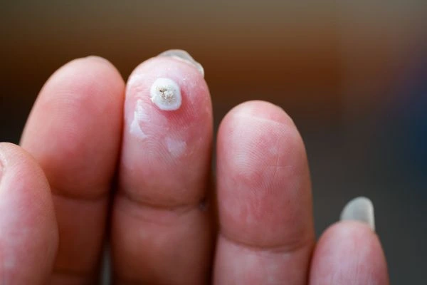 wart on person finger - cryotherapy to treat from LA LIPO Stratford New Town