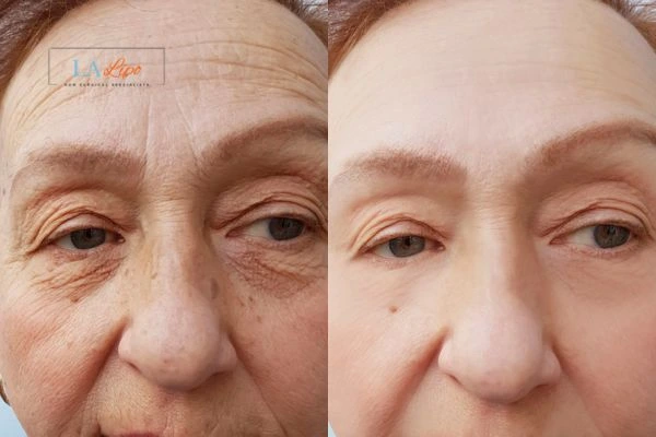 The powerful benefits of Morpheus8 Treatment Stratford New Town - Call Our team today!
