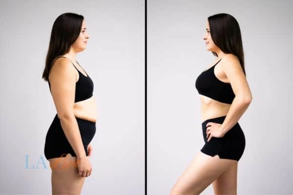 Picture of womans before and after using LA-EMS body sculpting to improve her core strength Stratford New Town