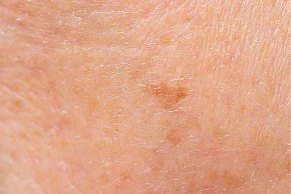 close up picture of age spots Stratford New Town