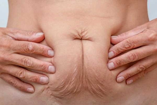 Image of a woman's stomach with loose skin - example of skin tightening Stratford New Town options